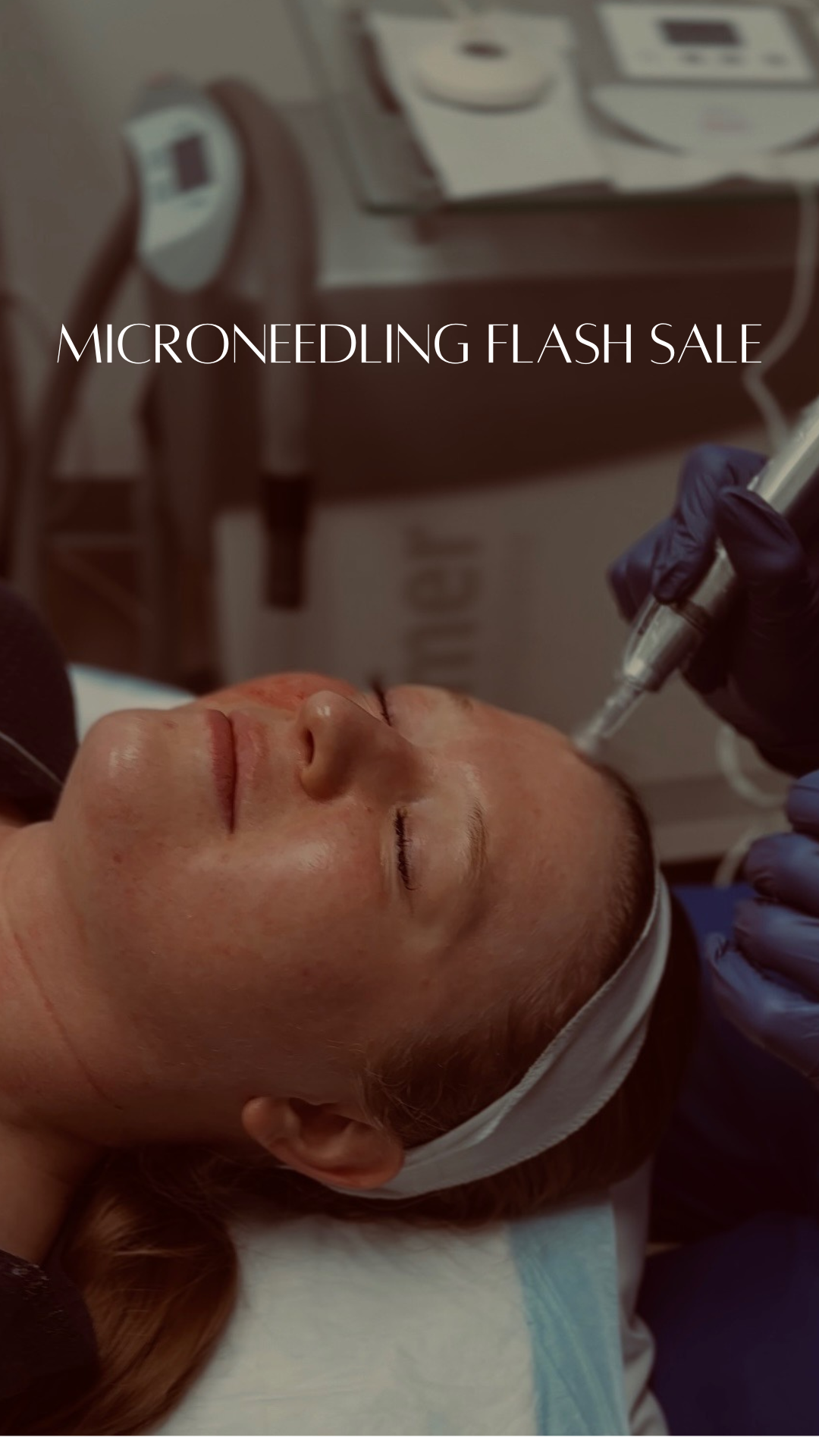 Microneedling Flash Sale